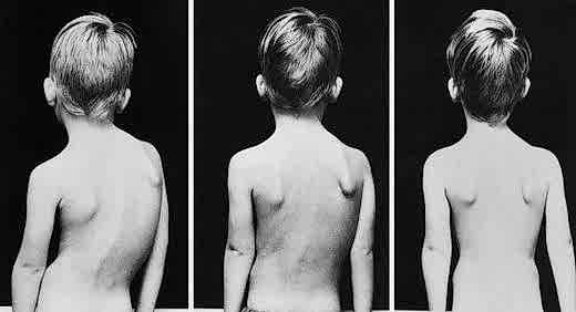 Duruş Bozuklukları İçin Pilates